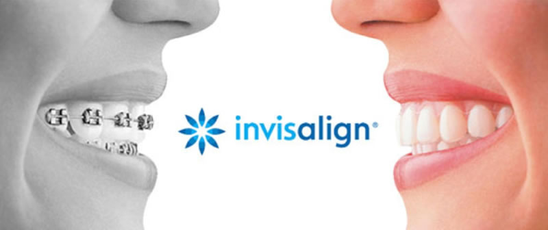 invisalign1