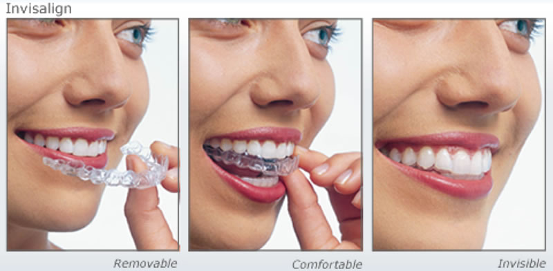 Invisalign Clear Braces Treatment for an Underbite in NYCDr. Jacquie